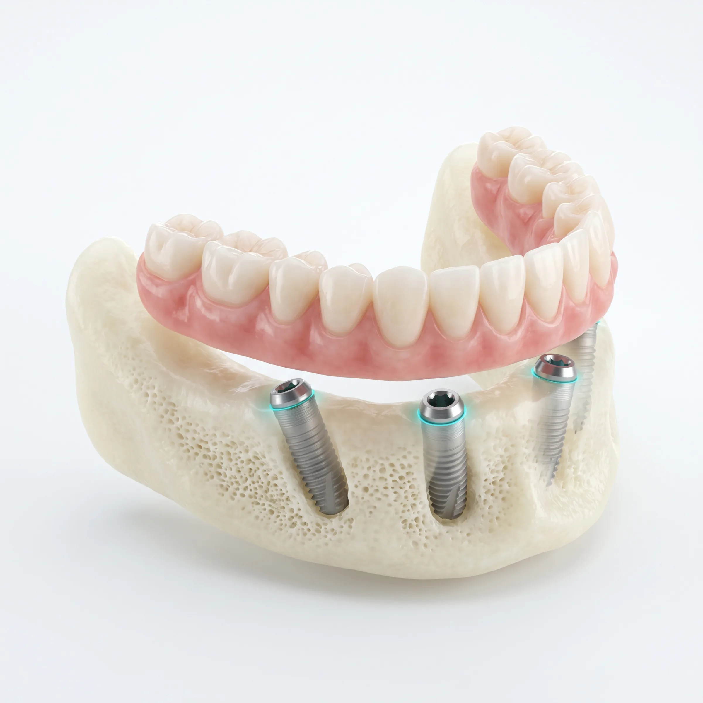 Tecnica All-on-4: protesi fissa su quattro impianti — riabilitazione completa