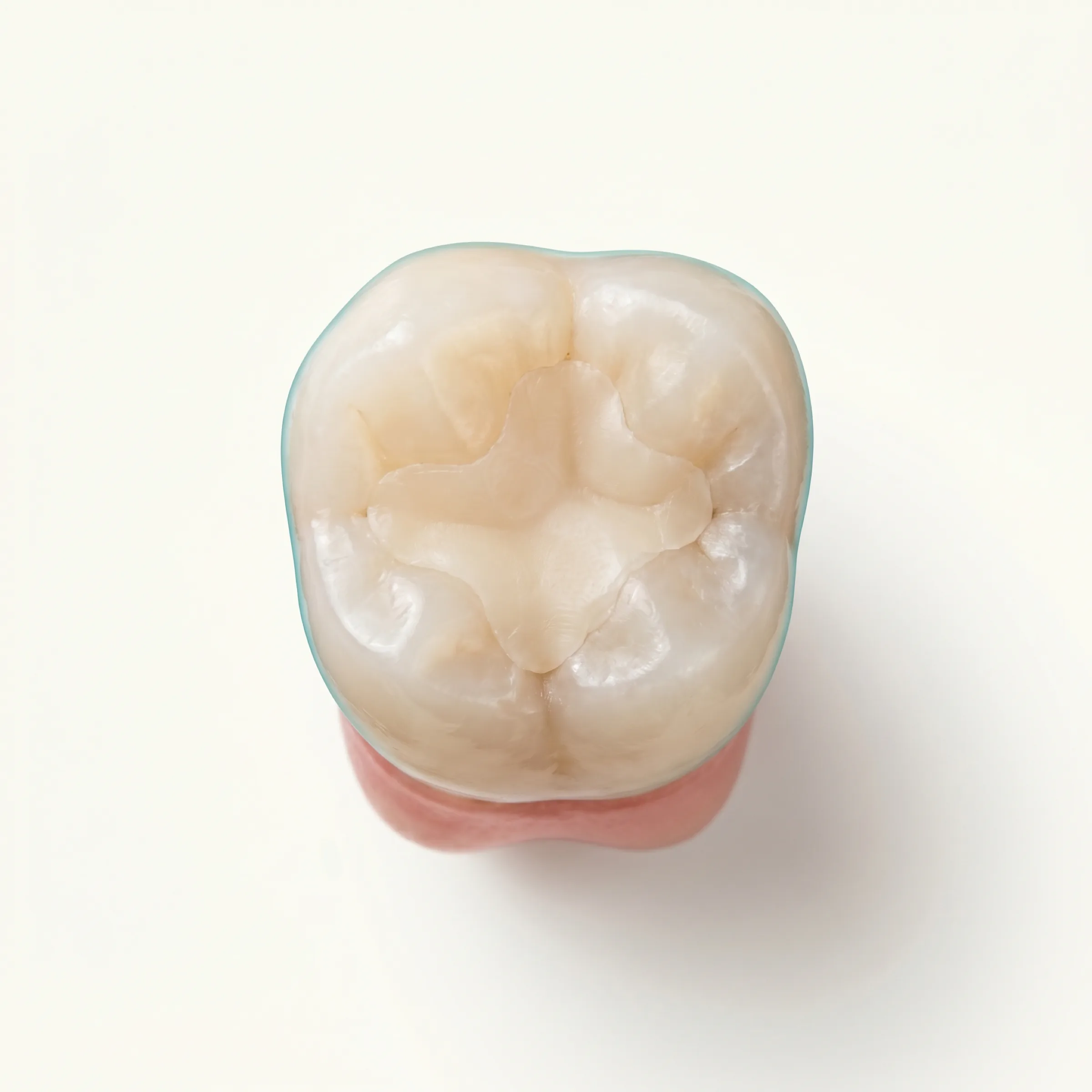 Otturazione in composito su dente cariato — restauro conservativo